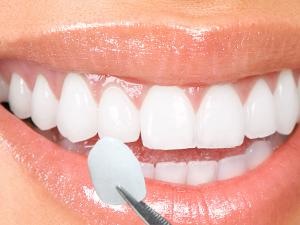 best dental implants in india 